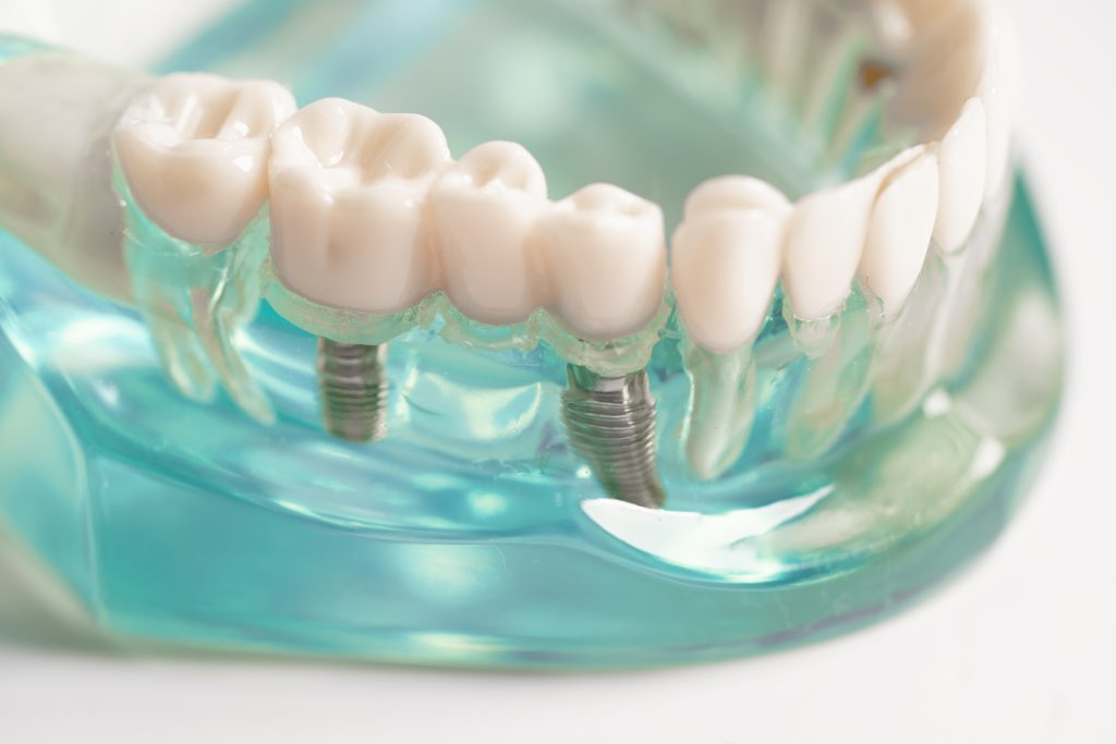 dental implants